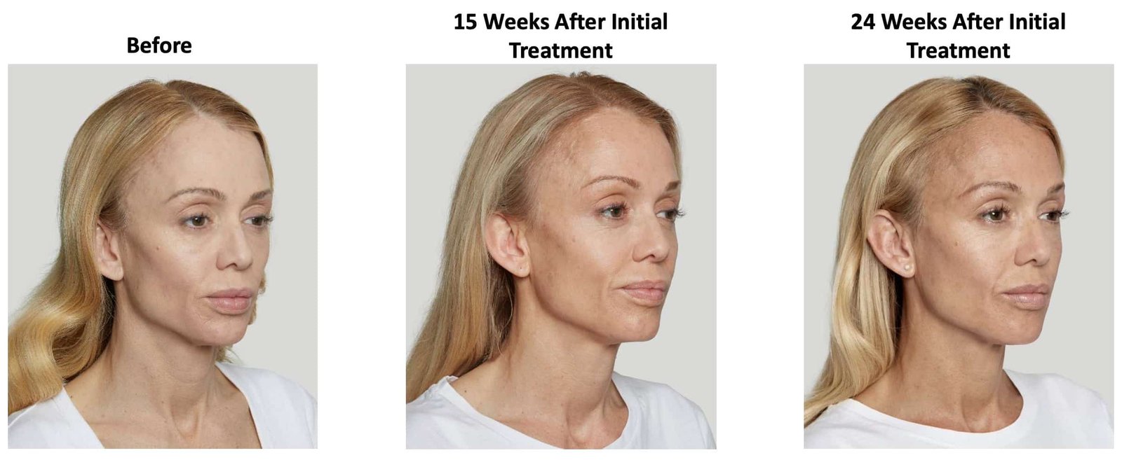 Before and After Sculptra Treatment Meridian ID