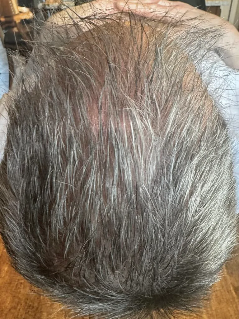 After Image: Derive Hair Restoration - back