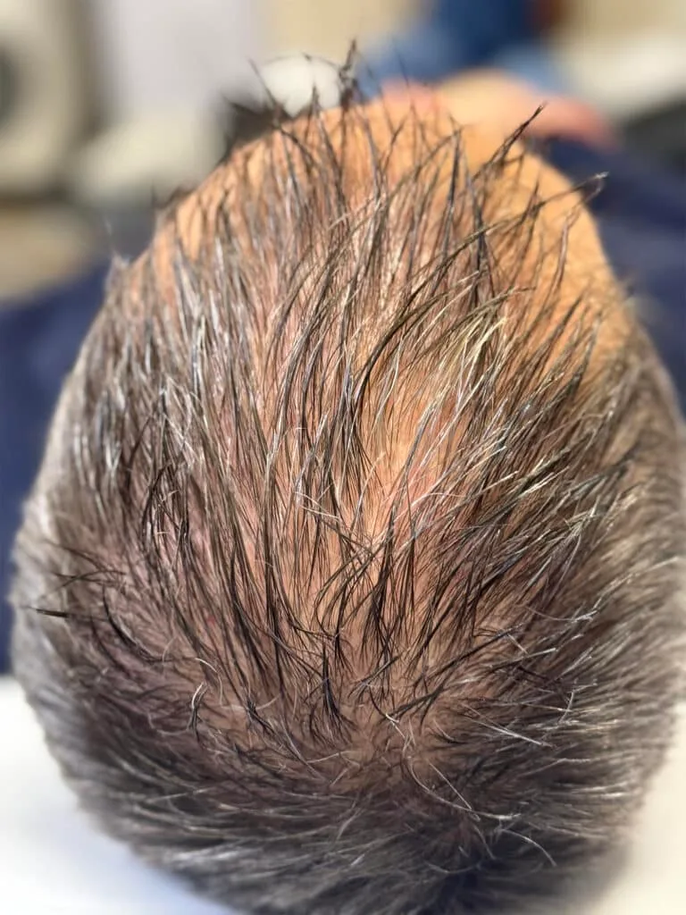 Before Image: Derive Hair Restoration - back
