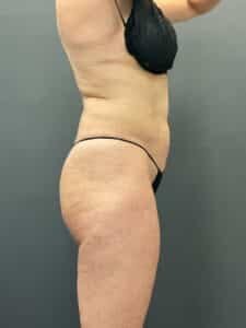 Before Image: Emsculpt Neo