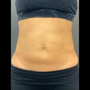 Before Image: Emsculpt Neo