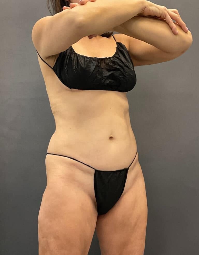 After Image: Emsculpt Neo Abs - right-front-oblique