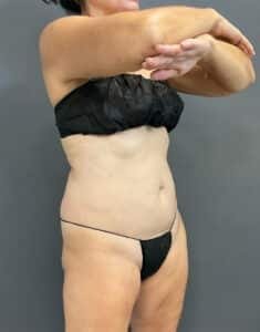 Before Image: Emsculpt Neo Abs