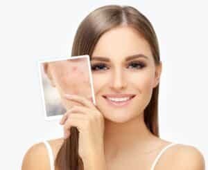 Woman with clear skin from RF microneedling holding a picture of her acne scars before